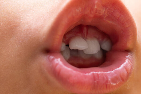 Crooked teeth in children