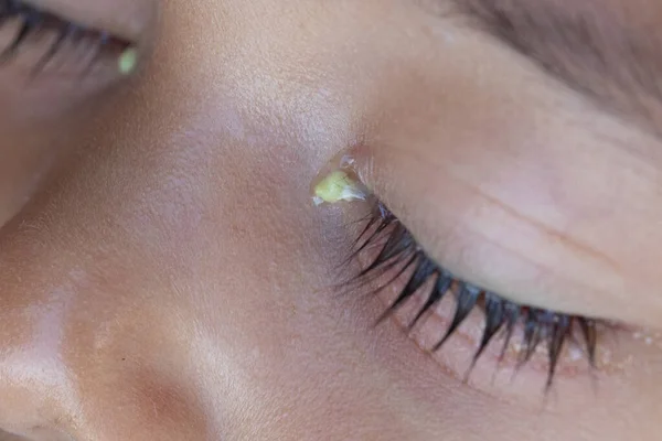 Экстремальный Крупный План Глазах Ребенка Страдающего Инфекционным Заболеванием Глаз Нижние — стоковое фото