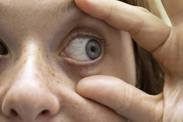 Menina Mostrando Capilares Vermelhos Globo Ocular Perto Médica — Fotografia de Stock