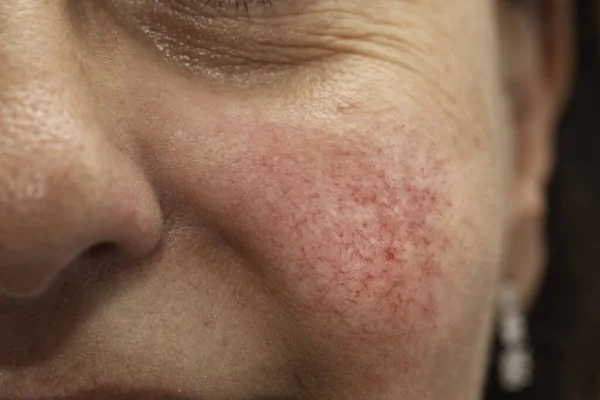 Extreme Closeup View Cheek Woman Her Forties Rosacea Sufferer Bright — Stock Photo, Image