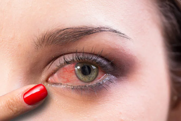 Finger Pointing Redness Woman Eye Caused Pollen Allergy — Stock Photo, Image