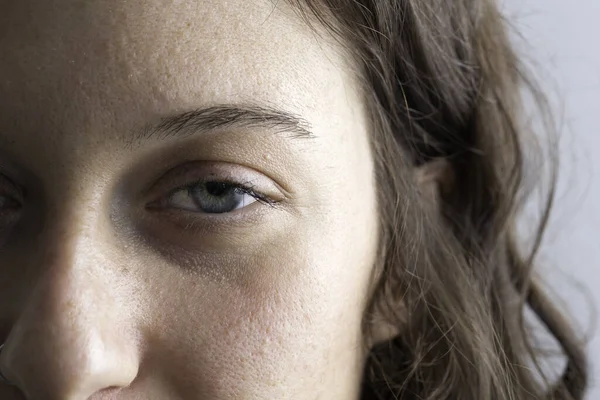 Fechar Rosto Mulher Mostrando Olho Afetado Pálpebra Caída — Fotografia de Stock