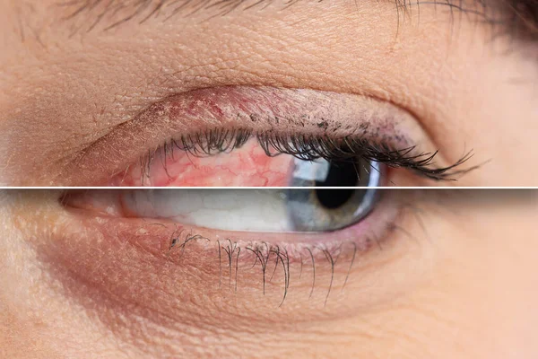 抗ヒスタミン薬治療の前と後の赤い目 — ストック写真