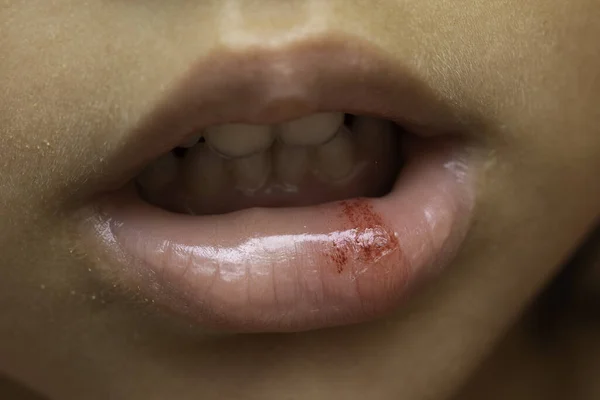 Nahaufnahme Der Blutigen Lippe Eines Mädchens — Stockfoto