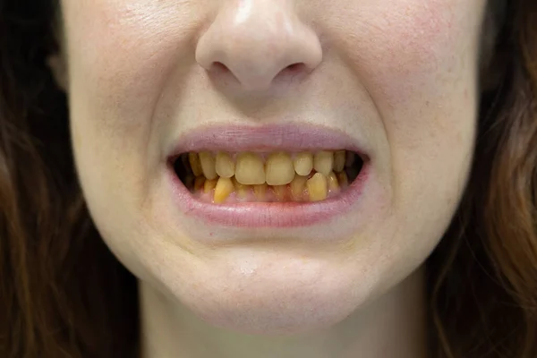 Closeup of girl showing yellowed teeth, dental care conjecture