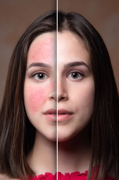Młoda Dziewczyna Trądzikiem Różowatym Przed Zabiegu Kosmetycznym Farmakologicznym — Zdjęcie stockowe