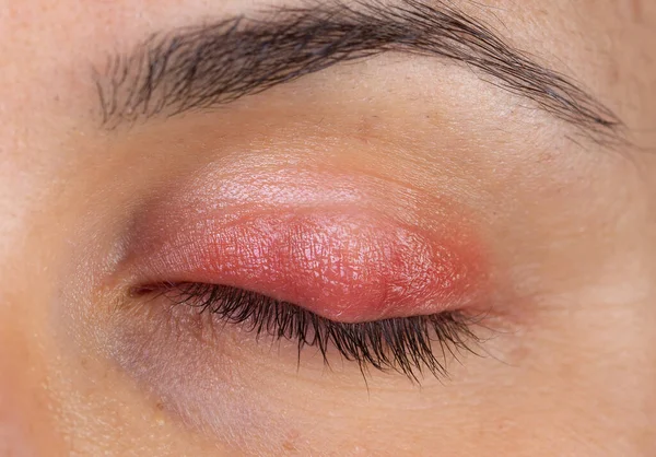 Macro view of a woman's eye with swollen and inflamed eyelid, symptomatic of a painful infection of the upper lid.