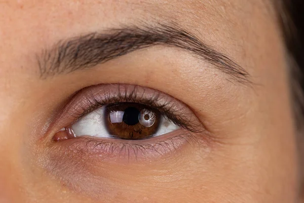 A closeup view on the eye of a young woman with a brown iris. Red and painful eyelids are seen in detail. Symptomatic of hayfever and eye allergies.