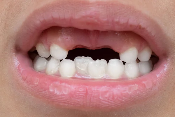 Sorriso Uma Criança Que Perdeu Primeiros Dentes Leite — Fotografia de Stock