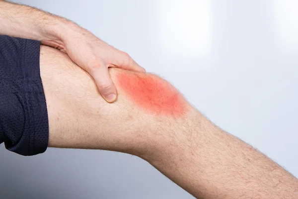 Hombre Tocando Enrojecido Rodilla Lesionada —  Fotos de Stock