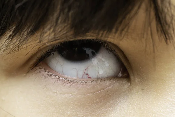 Ein Makroblick Auf Das Rollende Auge Eines Behinderten Vorschulkindes Der — Stockfoto