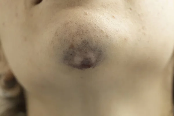 Bruise Person Chin Close — Stock Photo, Image