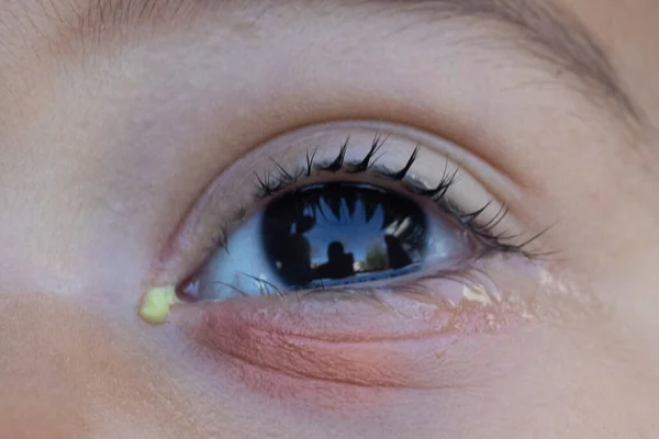 A closeup view on the red and sore eye of a young kid, with conjunctivitis. A common disease of the eye caused by viral infection or severe allergies.