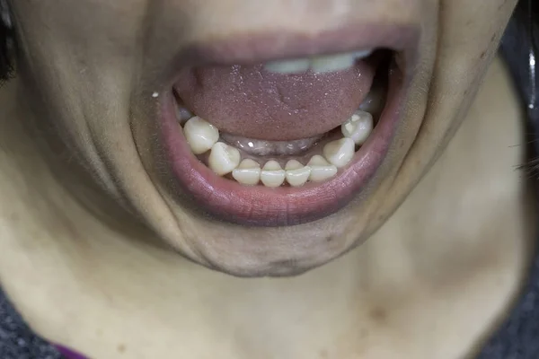 Wanita Dengan Mulut Terbuka Menunjukkan Gigi — Stok Foto