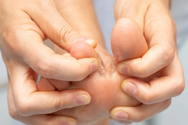 Closeup Barefoot Girl Suffering Athlete Foot Due — Stock Photo, Image