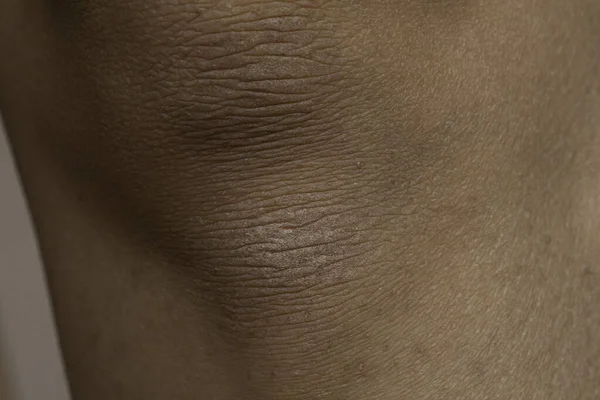 Emberi Térd Száraz Bőr Közelről — Stock Fotó