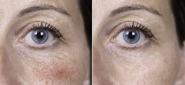 前と上頬から酒の症状を除去するために成功した外科的手順の結果の後に示す40歳の白人女性の青い目に近いビュー — ストック写真