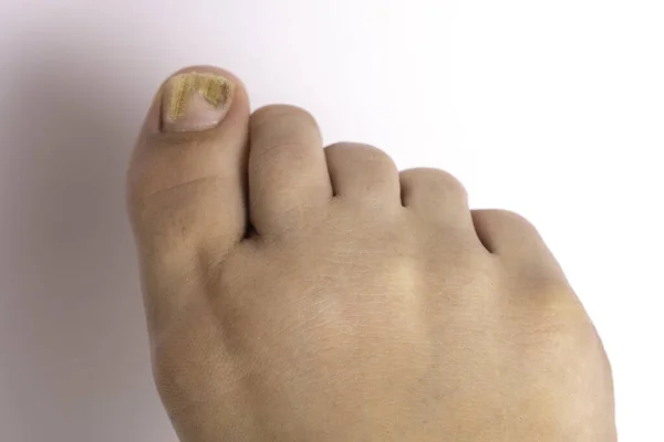 大きな爪の黄色の変色を引き起こす真菌感染症である白癬患者の裸の足に近いと上のビュー — ストック写真