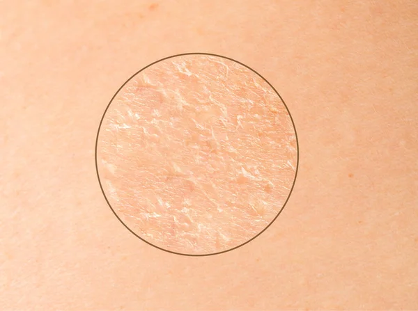 Details of human skin seen in extreme detail, with blurred edges of the from and focused circle showing dry skin and blemishes, dermatology and skincare concept.
