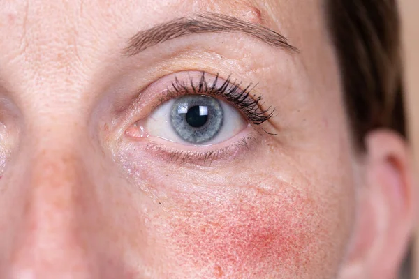 Olgun beyaz bir kadın yakından görülüyor, yanağında şiddetli rosacea var. Yüzeysel kan damarları yüzünde kırmızı ve lekeli deriye neden olur..