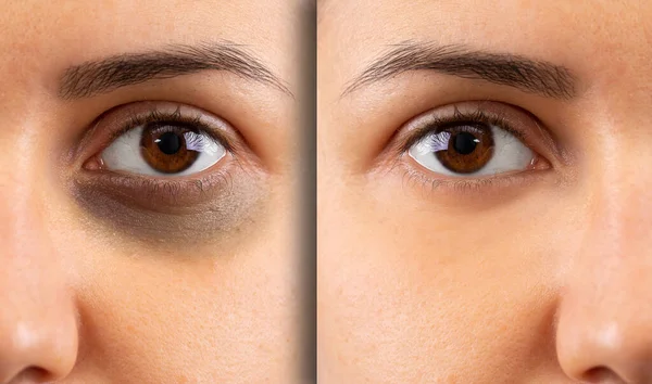 Close Shot Young Woman Black Bruised Eye Image Right Shows — Stock Photo, Image