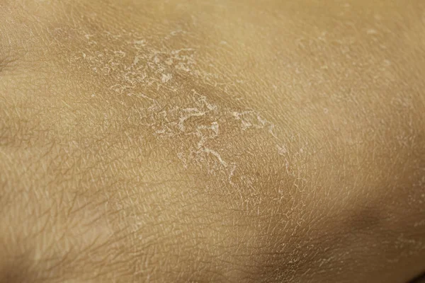 Una Vista Vicino Peeling Desquamazione Della Pelle Secca Bruciata Dal — Foto Stock