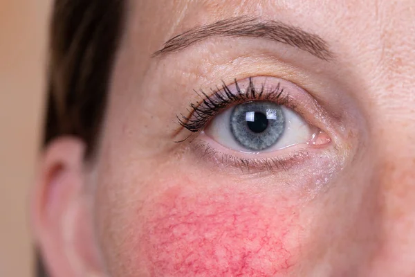 Closeup View Face Young Woman Suffering Rosac — Stock Photo, Image