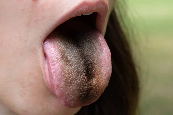 A caucasian woman sticks out her tongue to reveal an unsightly black coating. Symptomatic of a severe enterobacter cloacae bacteria infection. Copy space on the right.