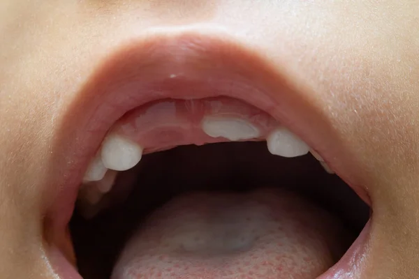앞니가없는 어린아이의 윗입술 잇몸을 가까이 수있다 — 스톡 사진