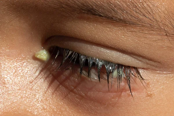 Vedere Macro Asupra Ochiului Unui Băiat Preșcolar Pleoapă Inferioară Roșie — Fotografie, imagine de stoc