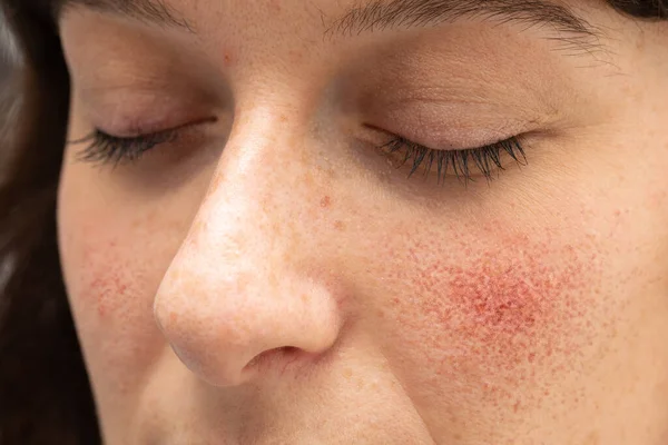 Problematic Skin Young Caucasian Woman Seen Close Red Blotchy Cheeks — Stock Photo, Image