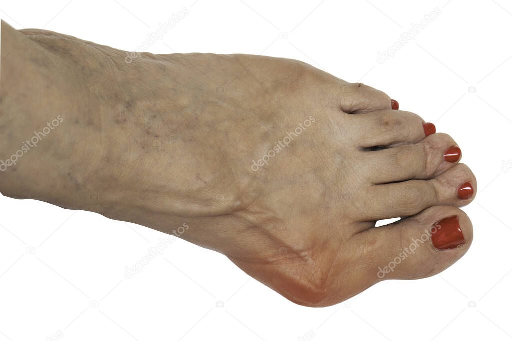 A closeup view on the bare foot of an elderly woman, showing a painful and swollen case of hallux valgus (bunion), red and inflamed isolated against a white background.