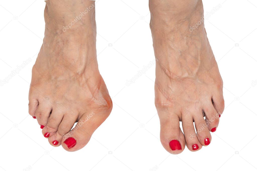 A closeup view on the feet of an older woman with red painted toenails. Deformation of the big toe is seen with a large bunion. Shot against a white backdrop.