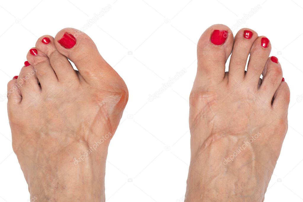 A close up and top view on the feet of an elderly woman suffering from severe hallux valgus causing the big toe to bend and twist, isolated against a white background.