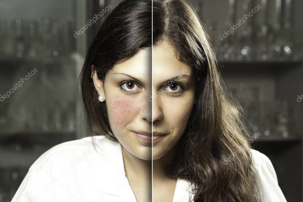 A before and after portrait of a professional woman who suffered from rosacea, resulting in rosy red cheeks, laser surgery gives a flawless complexion with confident smile.
