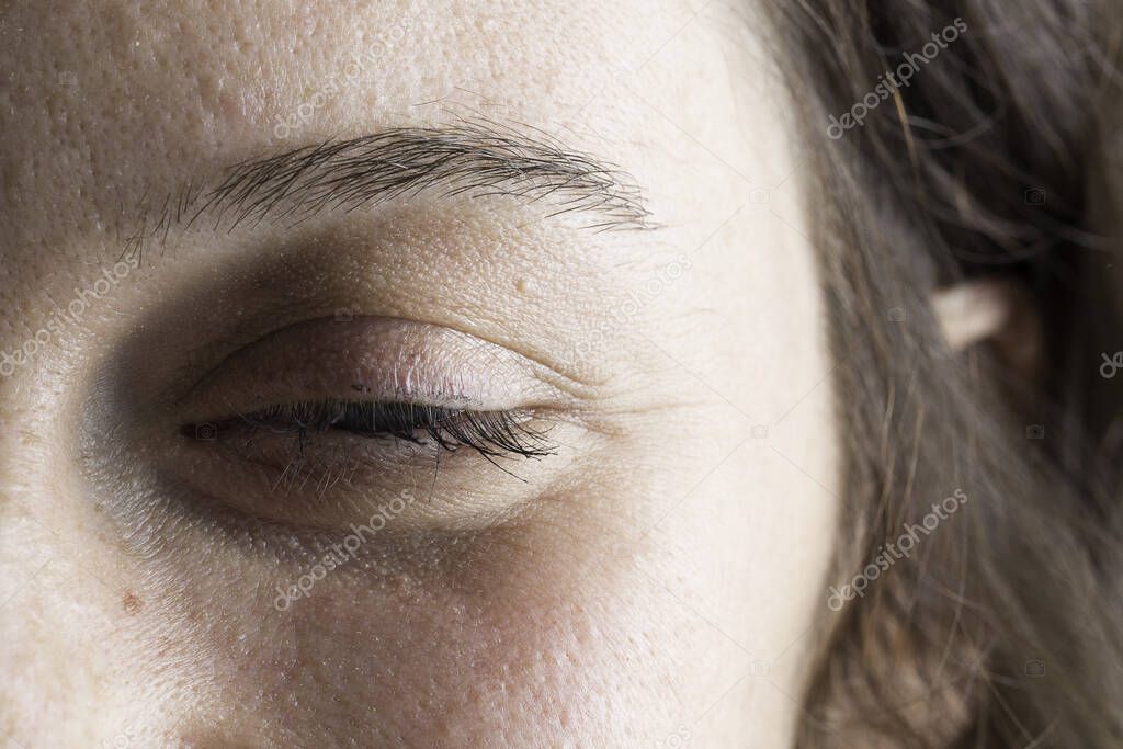 Extreme close up of woman eye suffering from drooping eyelid aft