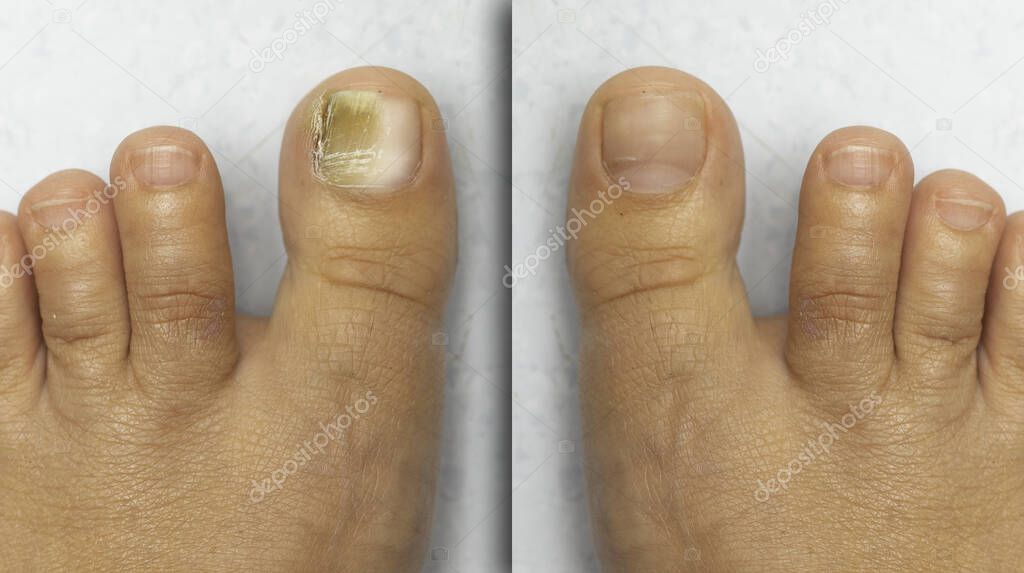 Before and after successful treatment for a fungal infection on toe