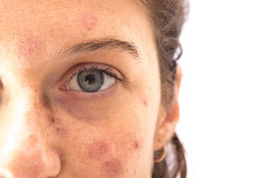 Güneşe maruz kaldığı için kızda kızarıklık oluşmuş.