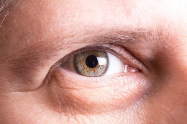 Poşetli kadının şiş gözü.