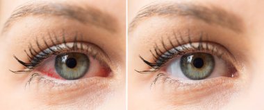Red eye of woman before and after eyewash treatment clipart