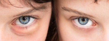 Aşağıdan bakan koyu mavi gözleri kapat, şişmiş olanı.