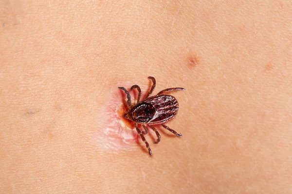 Tick biting human skin