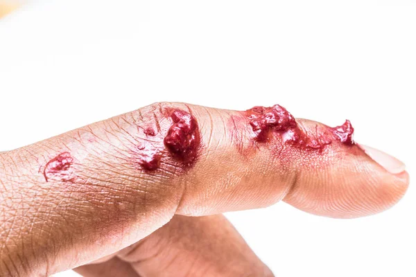 Simulation Bloody Finger Isolated White Background — Stock Photo, Image