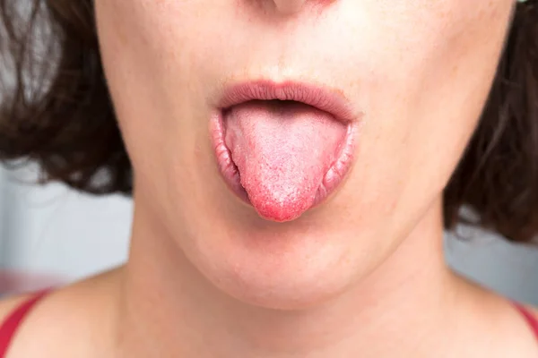 Primer Plano Lengua Femenina Para Controlar Candidiasis — Foto de Stock