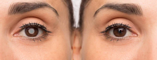 Olhos Femininos Antes Depois Cirurgia Com Sem Catarata — Fotografia de Stock