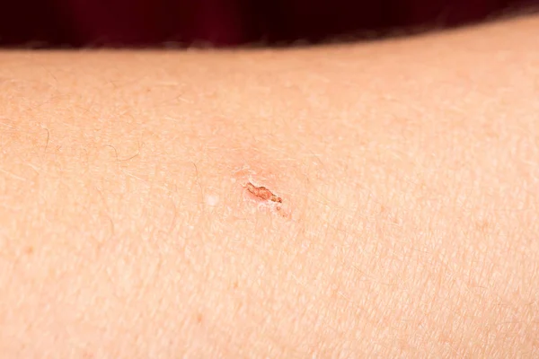 Cicatriz Uma Espinha — Fotografia de Stock