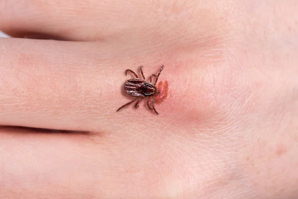 Tick biting woman hand