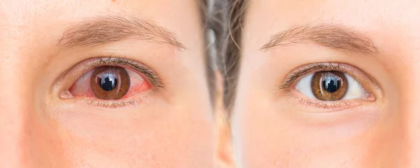 Röda Ögon Kvinna Före Och Efter Ögondusch — Stockfoto