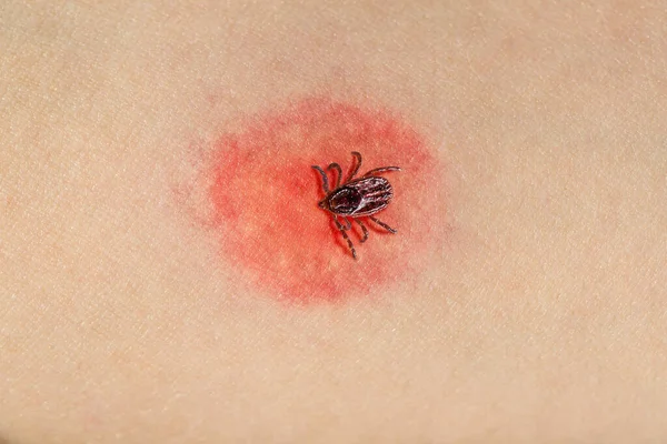 Tick biting human skin and causing dangerous disease