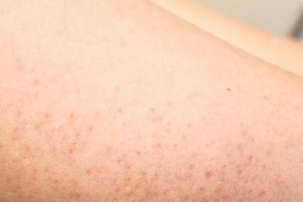 Celulitis Los Muslos Una Dama — Foto de Stock